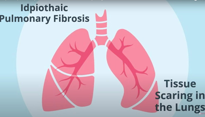6 Hidden IPF Warning Signs