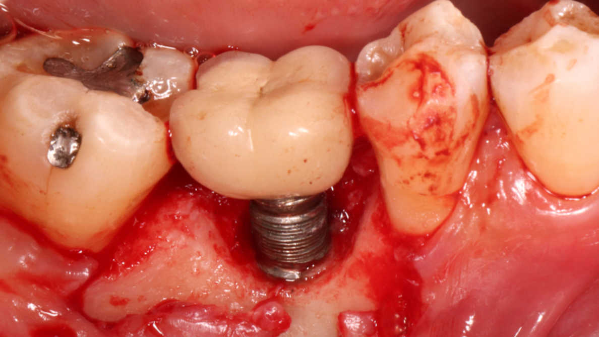 Early and Late Dental Implant Problems