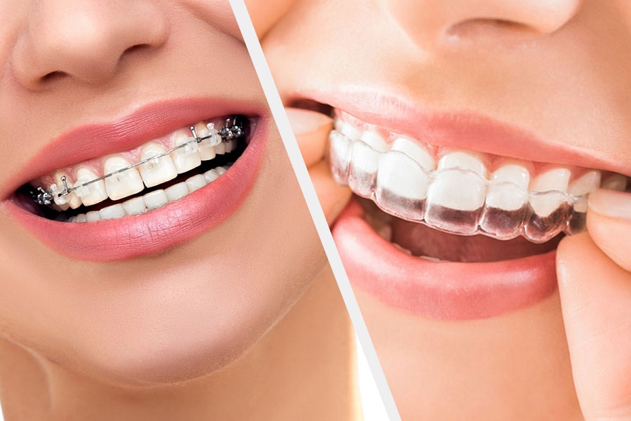 Braces vs. Invisalign