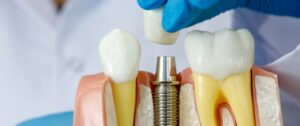 Dental Implants Hawthorn East